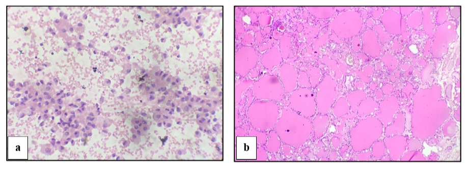 Cytological Study of Thyroid Lesions using the Bethesda System and Histopathological Correlation