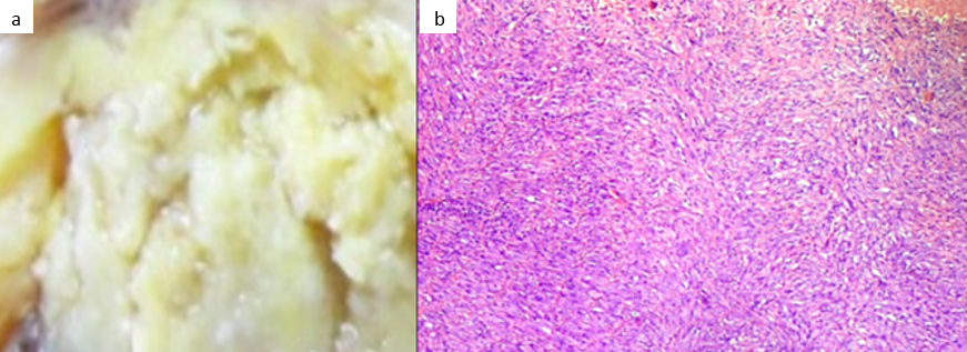 a: Cut Surface of tumour, firm in consistency an yellow white in colour; b: Haematoxylin & eosin stained section from the tumour, showing spindle shaped tumour cell tumour arranged in a herringbone pattern (10X)