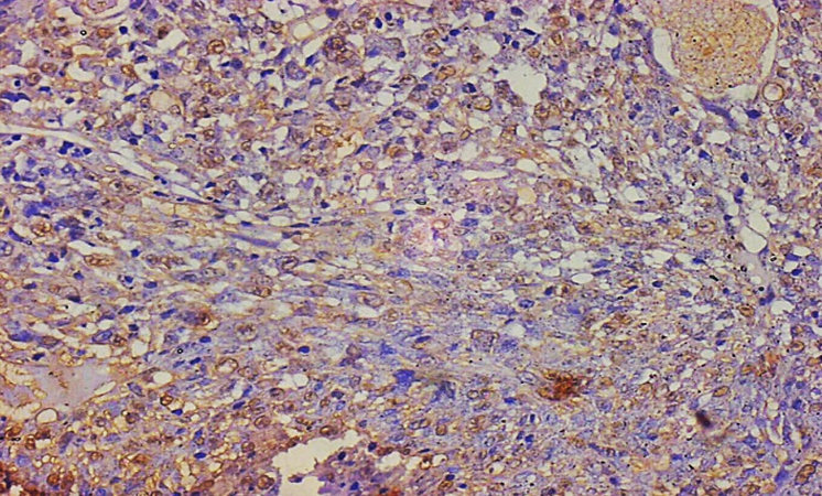 Tumour cells show diffuse cytoplasmic positivity for Vimentin (20X)