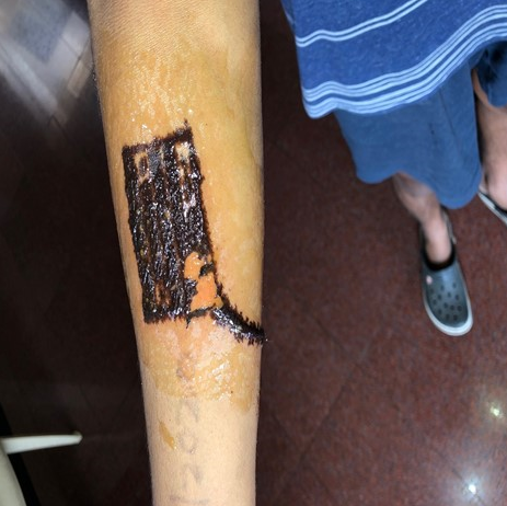 Irritant reaction noted along the areas of ink spillage.