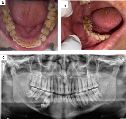 a: Intraoral picture showing missing 45; b: Intraoral picture of the swelling; c: Orthopantomogram of the lesion