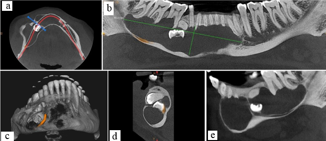 a: Axial section (CBCT); b: Panoromic reconstruction showing the extend of the lesion; c: 3D reconstruction section; d & e: Saggital section (CBCT)