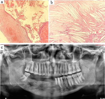 a: Histopathological image showing cyst wall lined by stratified squamous epithelium; b: Wall of the cyst displaying cholesterol clefts with foreign body giant cell reaction; c: Orthopantomogram after one –year follow up