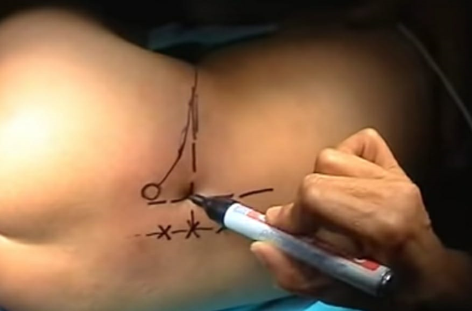Approach for psoas compartment block