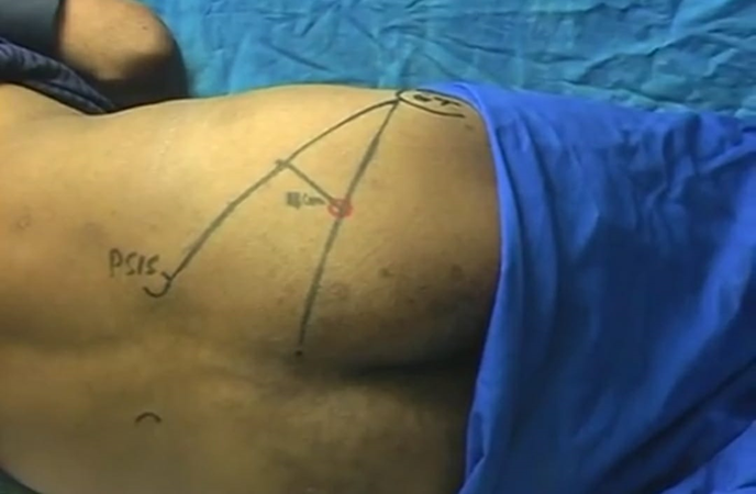 Labat’ approach for sciatic nerve block