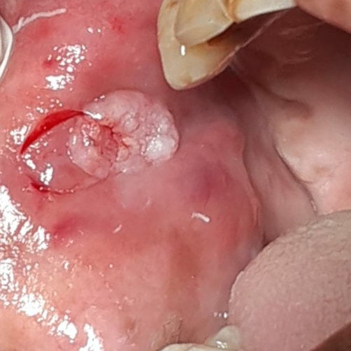 Incision given