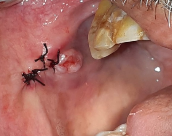 Sutures placed