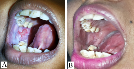 A: Baseline; B: After 3 sessions of I/L PRP 