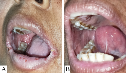 A: Baseline; B: After 3 sessions of I/L PRP