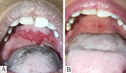A: Baseline; B: After 3 sessions of I/L PRP