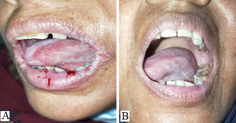 A: Baseline; B: After 3 sessions of I/L PRP 