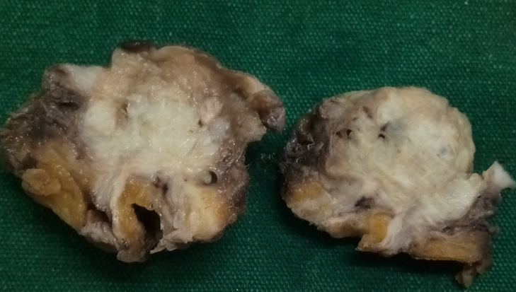 Cross section of Umbilical nodule showing tiny hemorrhagic spots.