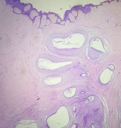 Skin with underlying endometriotic glands and stroma