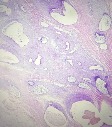 Dilated endometrial glands with luminal secretions.