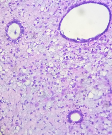 Stromal decidualisation around glands.