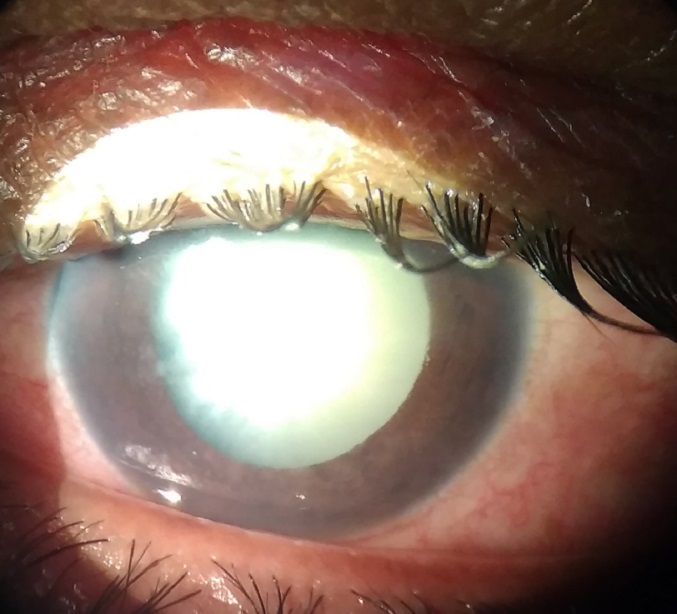 Phacomorphic glaucoma