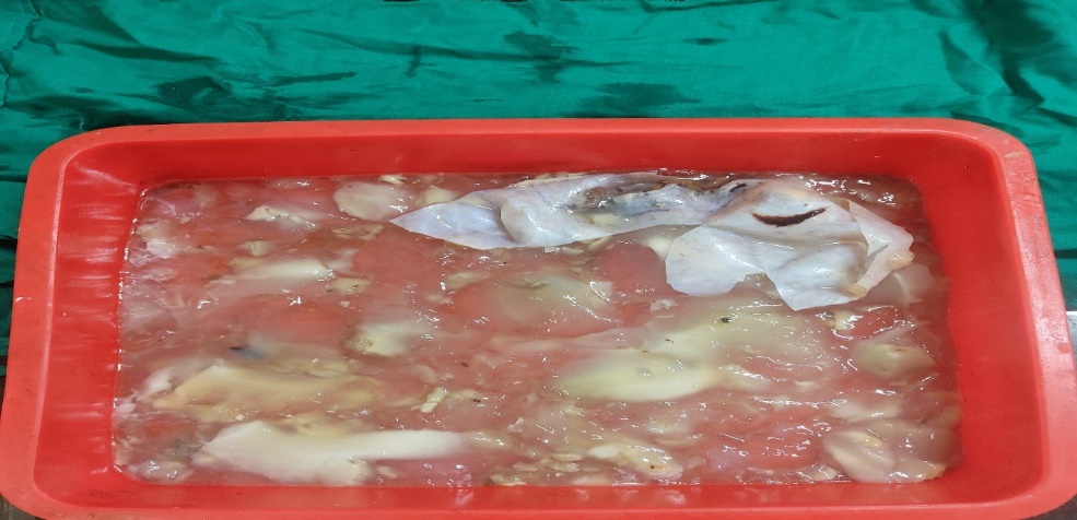 Gross photograph of mucinous cystadenoma showing cyst wall with thick mucinous contents in it