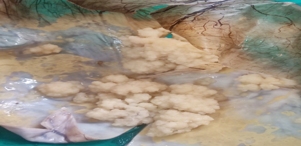 Gross photograph of case of low grade serous cyst adenocarcinoma showing papillary excrescences