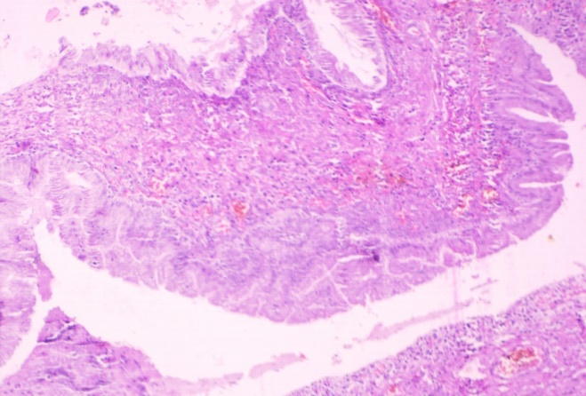 Photograph showing fibrovascular cyst wall lined by mostly single layer of columnar epithelium with basal layer and apical mucin vacuoles showing focal complex architecture and focal nuclear atypia. (H and E, x10)