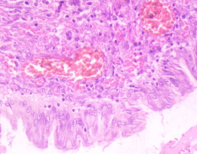 Photograph showing fibrocollageneous cyst wall with congested blood vessels lined by single layer of benign columnar cells with apical mucin vacuoles. (H and E, x40)