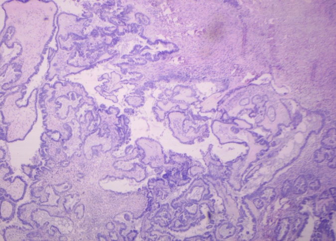 Photograph showing tumour cells arranged in papillary pattern with more than 0.5cm invasion into the stroma. Some tumour cells show nuclear crowding, overlapping, clearing, few of the nuclei also shows nuclear grooves. (H and E, x4)