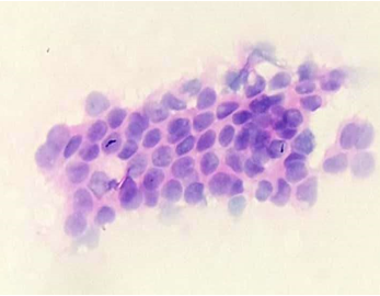 H&E-Showing ductal epithelial cell cluster under 100x