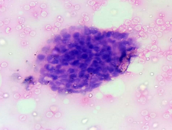 H&E- cluster of ductal epithelial cell lacking myoepithelial layer under 100X 