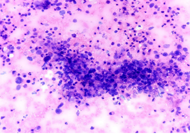 H&E- Loose cohesive cells with anisonucleosis under 100x 