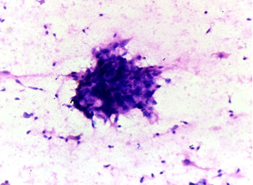 H&E-Cluster of highly pleomorphic cells with increased N:C ratio