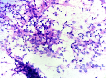 H&E- Dispersed arrangement of pleomorphic cells under 40x