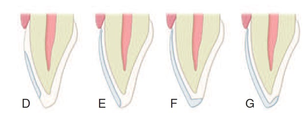 Types of veneers# partial veneer (D); full veneer with window preparation design (E); full veneer with butt-joint incisal preparation design (F); full veneer with incisal-lapping incisal preparation design (G).