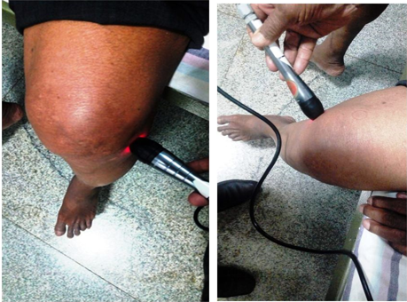 Laser probe to be placement on the surface of the skin around knee joint