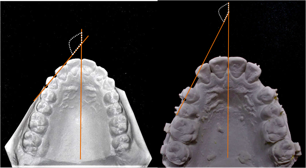 Measurement of distopalatal rotation of canine from pre and post retraction cast