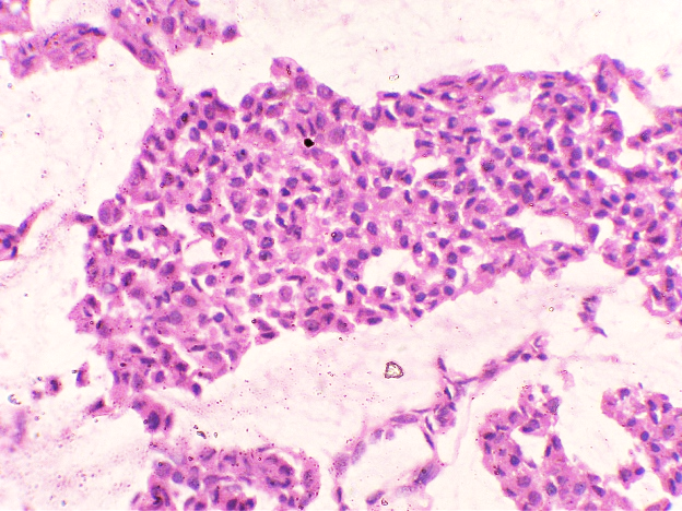 High power view of individual oval tumour cells with eosinophilic cytoplasm and vesicular nuclei