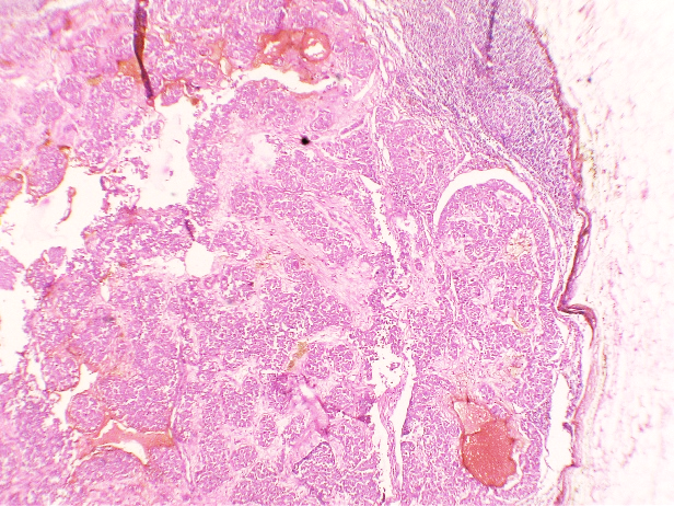 Low power view of lymph node showing tumour deposits surrounded by perineural fat