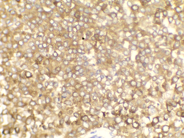 High power view showing positivity for synaptophysin
