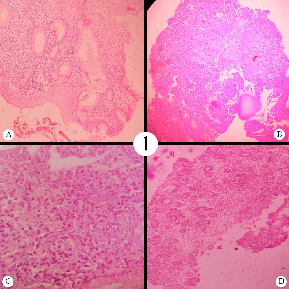 A: Barrett’s oesophagus(10x H and E); B: Well Differentiated Squamous Cell Carcinoma oesophagus(10x H and E); C: Poorly Differentiated Adenocarcinoma oesophagus(40x H and E); D: Atrophic Gastritis(4x H and E)