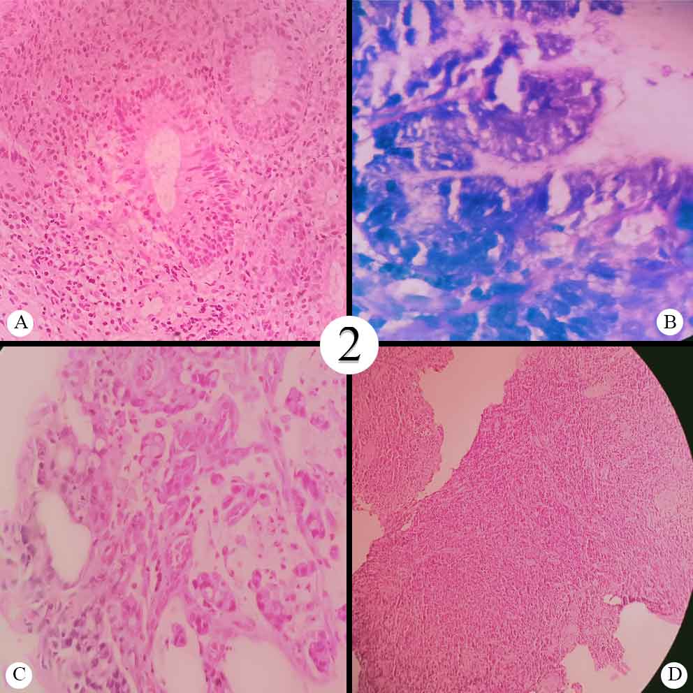 A: Chronic Active Gastritis(40x H and E); B: H.Pylori (100x Giemsa); C: Signet Ring Adenocarcinoma Stomach (40 x H and E);  D: Lymphoma Stomach (10x H and E)