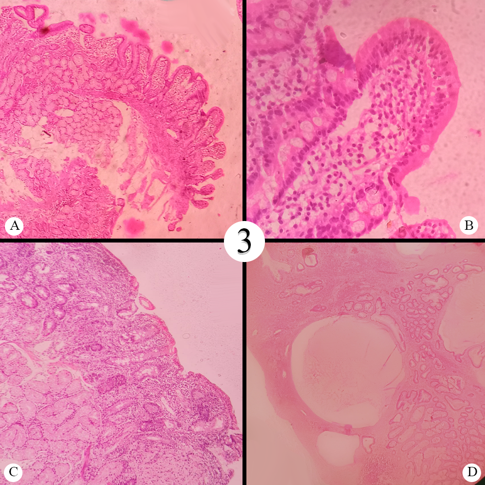 A: Modified Marsh Grade 3a Celiac; B: Modified Marsh Grade 3b Celiac; C: Modified Marsh Grade 3c Celiac; D: Juvenile Polyp Colon
