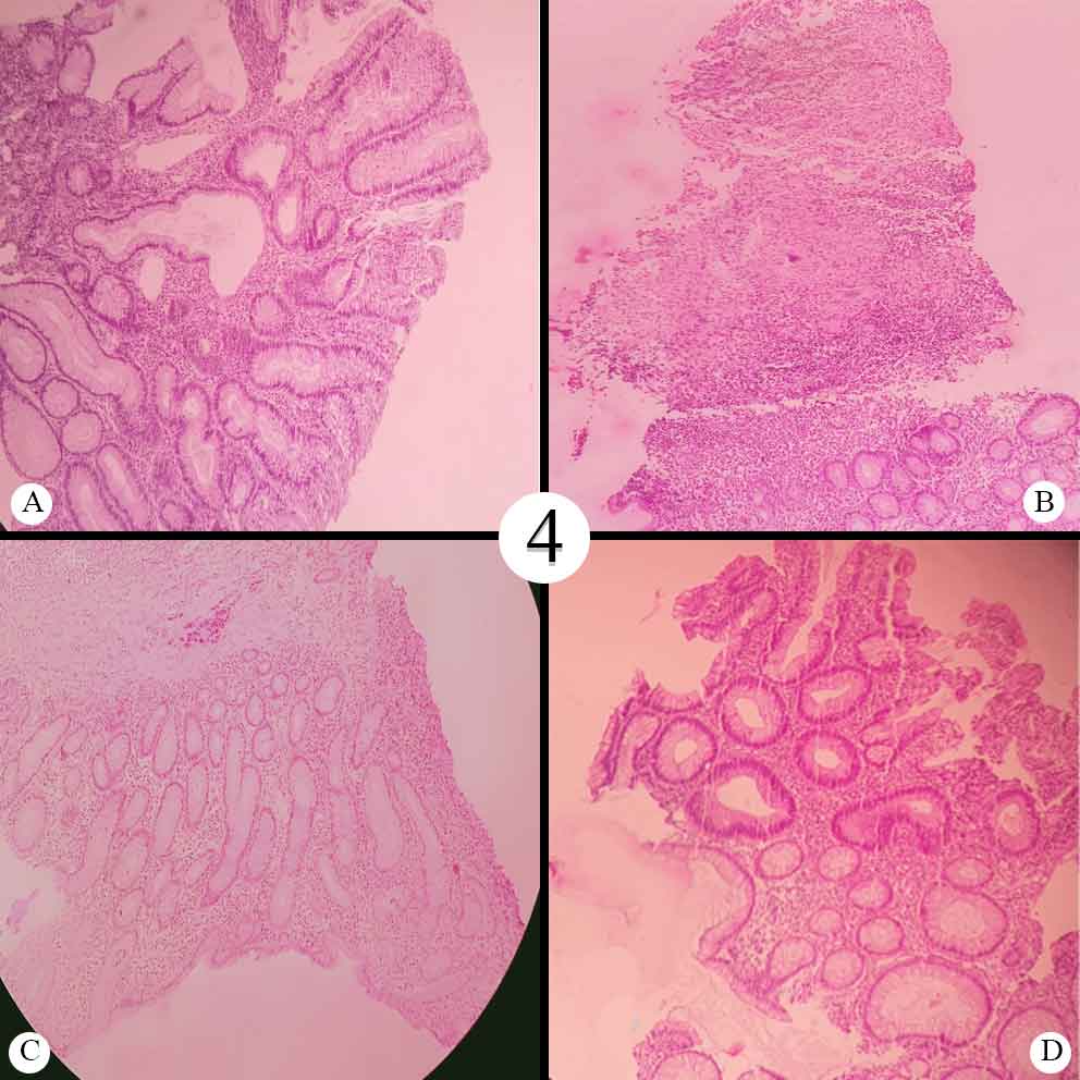 A: Non Specific Colitis; B: Granuloma Colon; C: Crohn’s Colon; D: Adenomatous Polyp with Dysplasia 