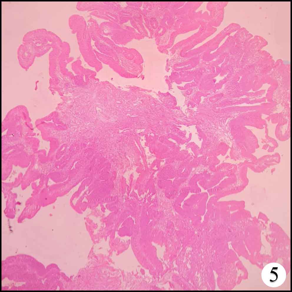 Adenocarcinoma colon