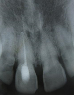 Post obturation radiograph