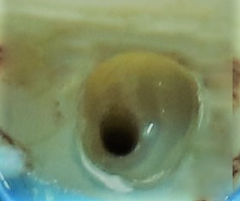 Clinical image of prepared canal