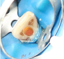 Obturation done with lateral condensation