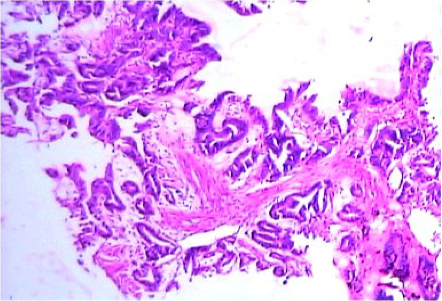 Well-differentiated adenocarcinoma- stomach; showing irregular atypical glands lined by pleomorphic cells (H & E, 40x)