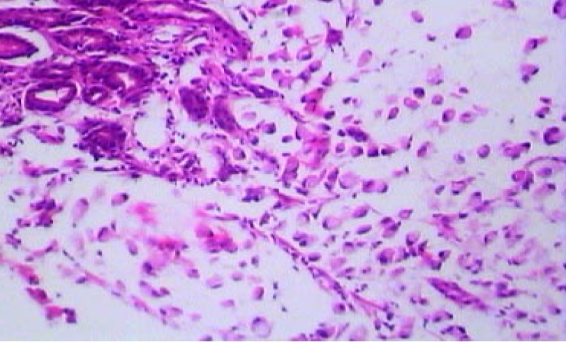Signet ring cell carcinoma - stomach (H & E, 100x)