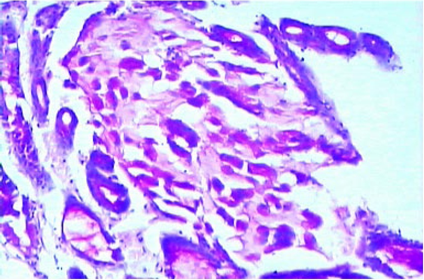 PAS stain showing positivity for signet ring carcinoma - stomach (100x)