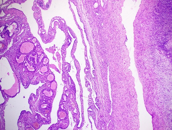 Fibrocollagenous cystwall focally lined by flattened epithelium (Right side) and colloid filled follicles of varying sizes lined by cuboidal epithelium (Left side) [H&E at 40x]
