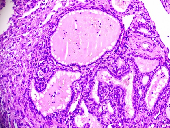 Colloid filled follicles of varying sizes lined by cuboidal epithelium [H&E at 200x]