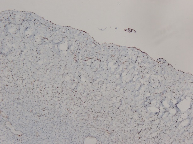 Fibrocollagenous cystwall lined by flattened epithelium, which shows diffuse strong nuclear positivity for WT-1